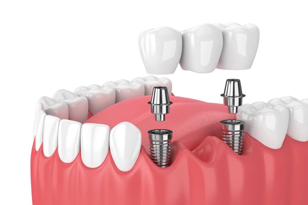 How Long Do Dental Bridges Last blog