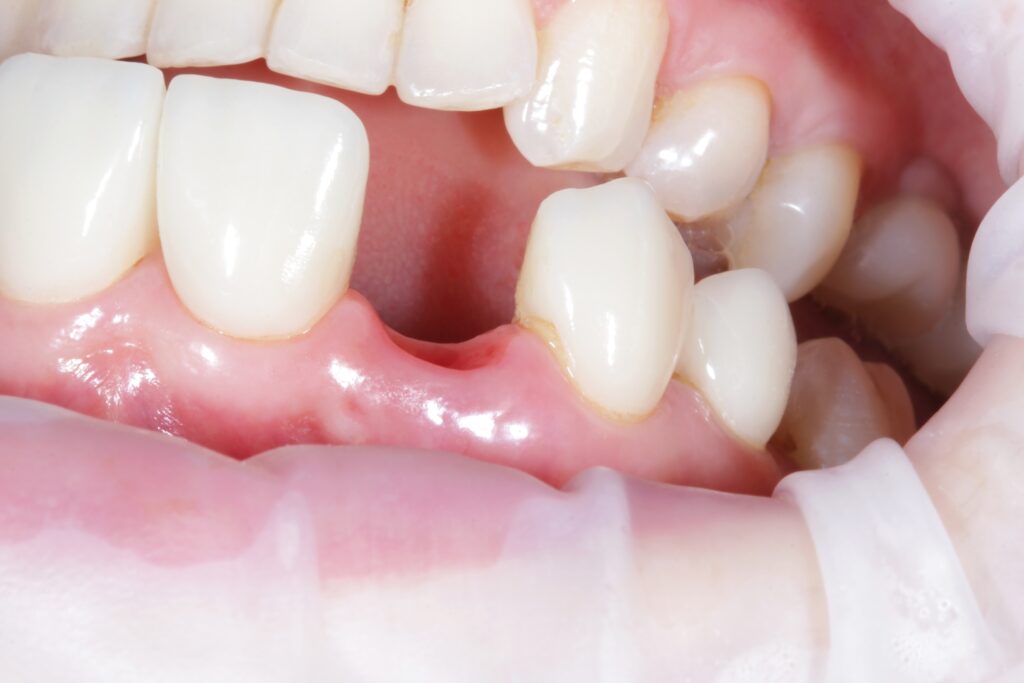 Close-up of a woman’s smile showing a missing front tooth, highlighting the need for gap tooth repair through restorative dentistry