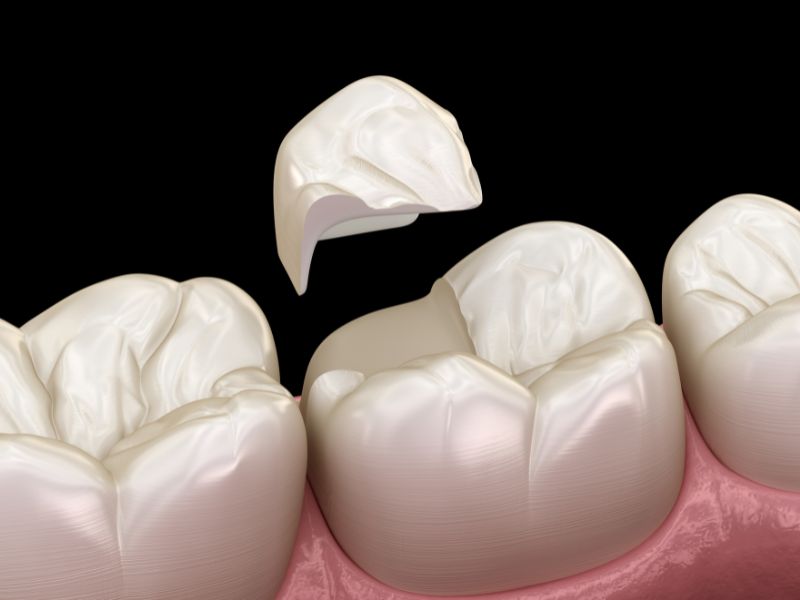 Benefits of Same-Day Dental Crowns vs. Traditional Crowns