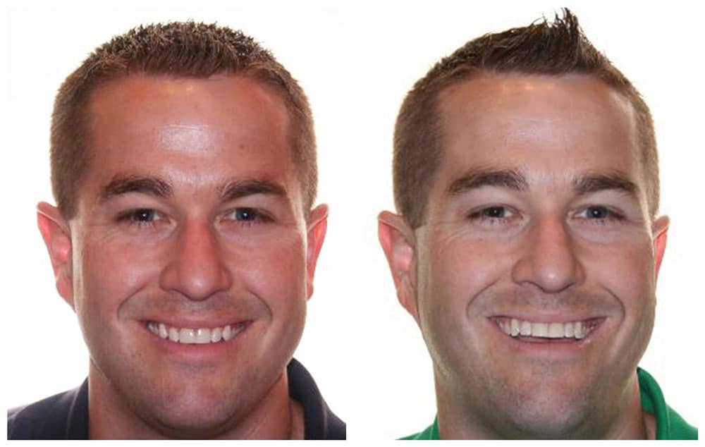 adult male before and after photos after using Invisalign