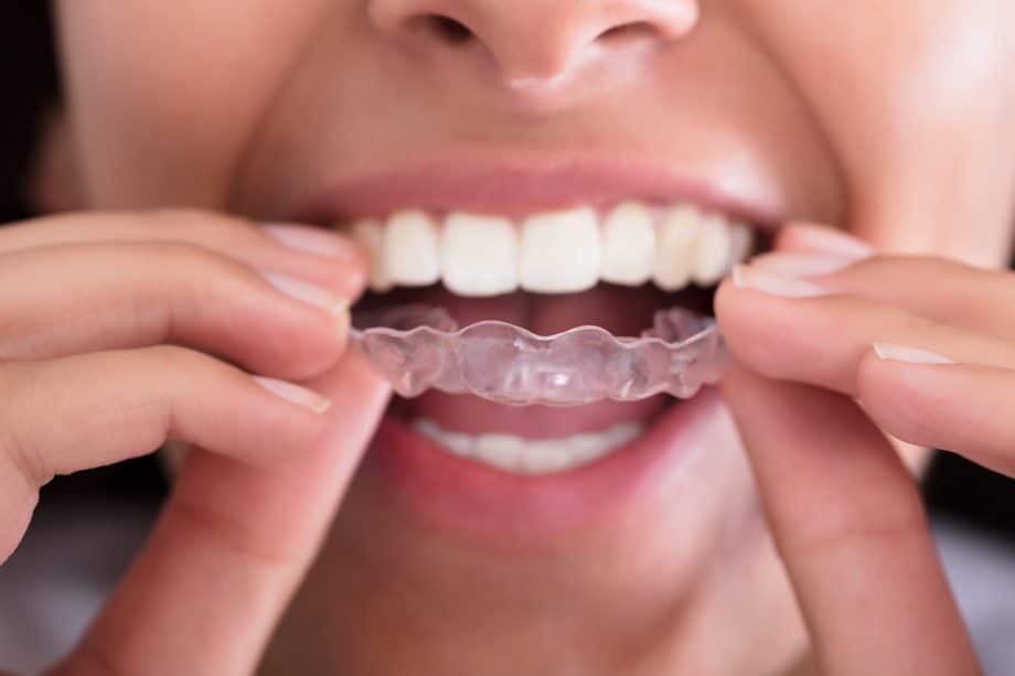 person smiles as they remove clear aligner from their mouth