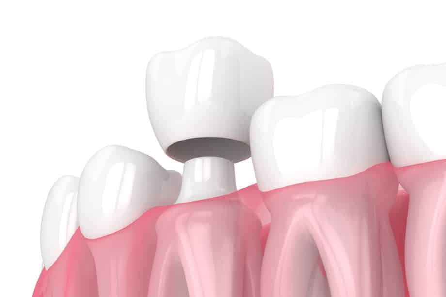 How Long Should Your Tooth Be Sensitive After Getting A Crown?