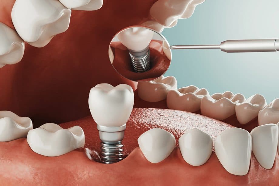 illustration of a dental implant in process