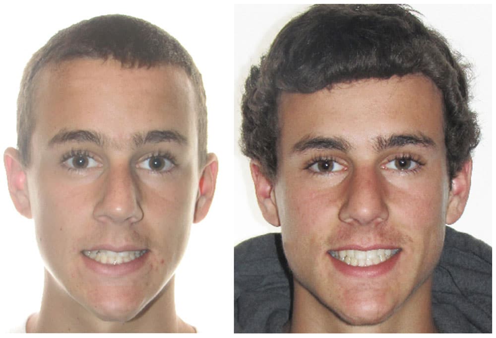 male teen before and after photos after using Invisalign