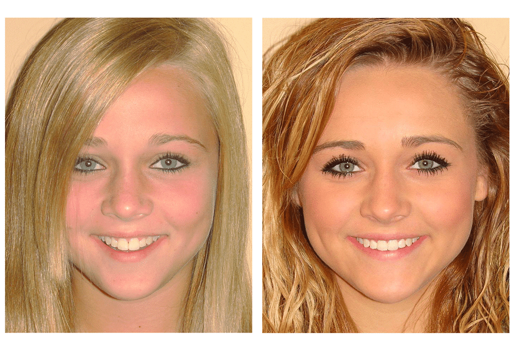 female teen before and after photos after using Invisalign
