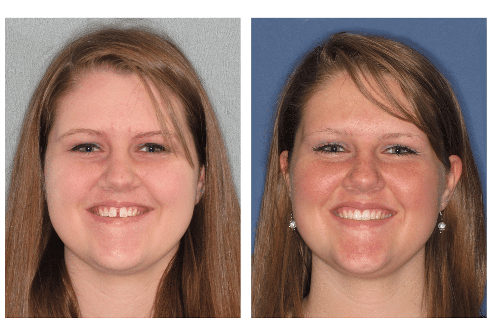 teen female before and after photos after using Invisalign